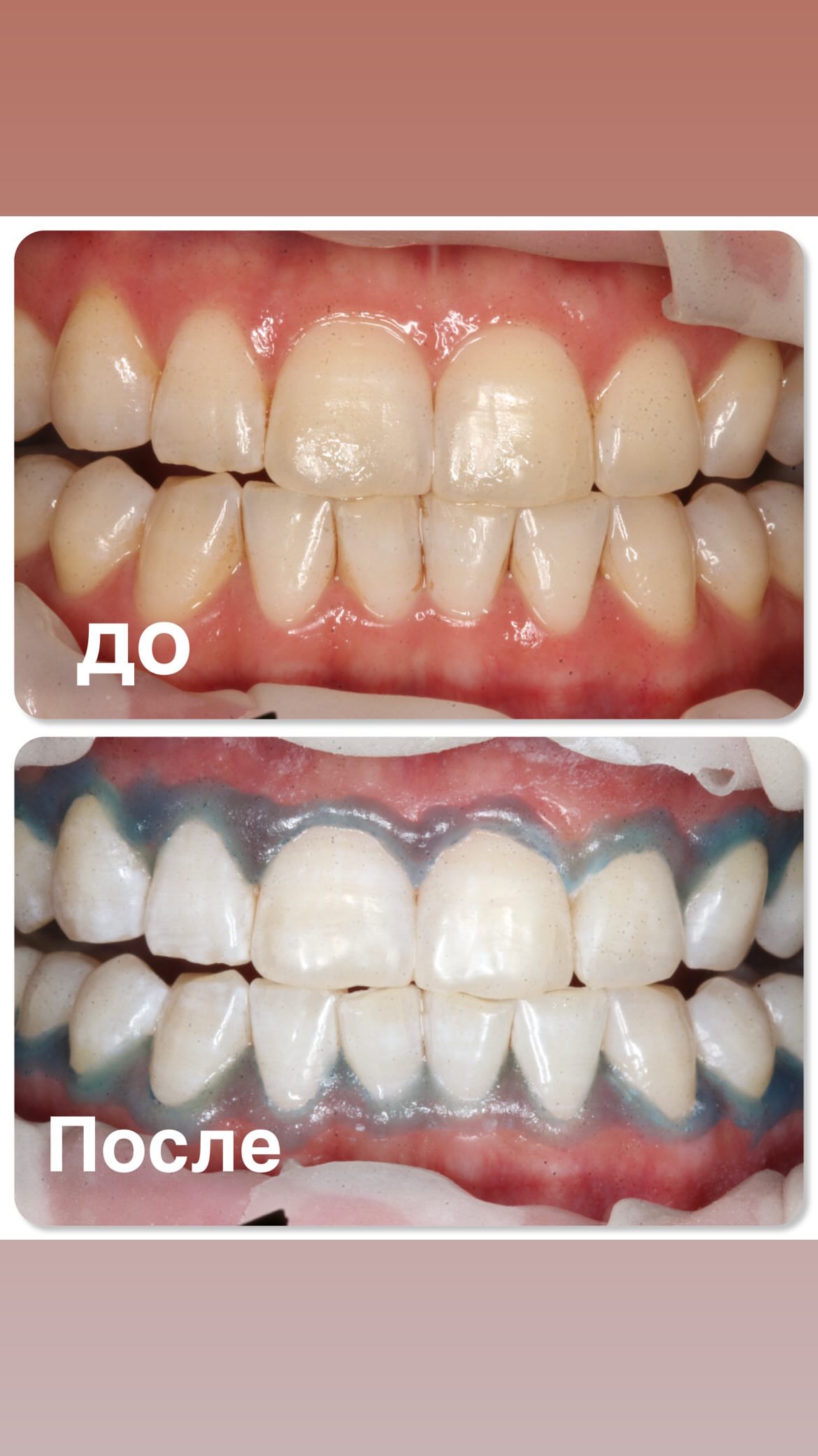 Отбеливание зубов